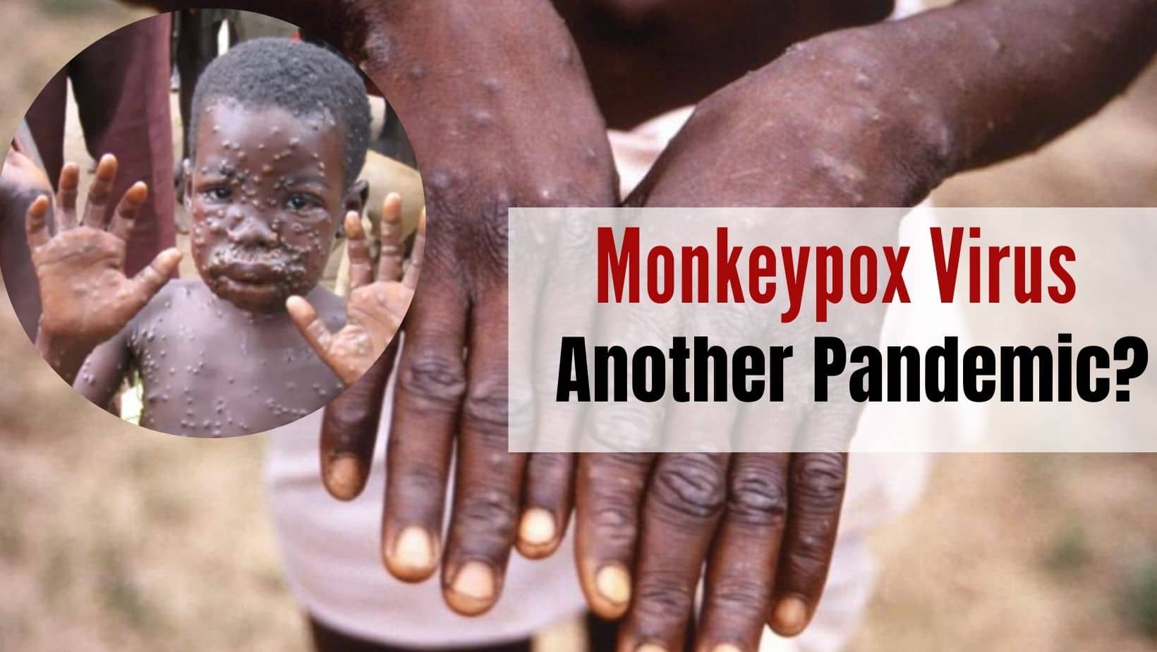 Are Indians At Risk of Monkeypox Outbreak Too? Virus Spreading Rapidly In Europe, North America
